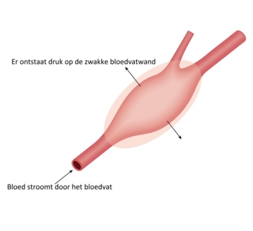 wat-is-een-aneurysma-visual